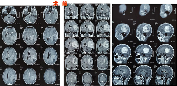 3歲有斗雞眼，父母忽視，13歲發(fā)現(xiàn)巨大腦腫瘤，這些癥狀需警惕!