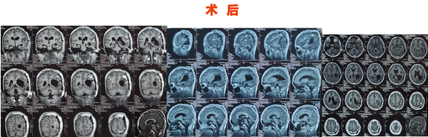 3歲有斗雞眼，父母忽視，13歲發(fā)現(xiàn)巨大腦腫瘤，這些癥狀需警惕!