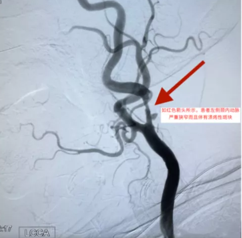 頸內(nèi)動(dòng)脈支架術(shù)中栓子脫落太多險(xiǎn)象環(huán)生 專(zhuān)家巧妙化解