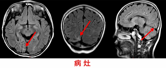 10歲男童癲癇4年 精準手術切癲癇灶“除根”-病灶