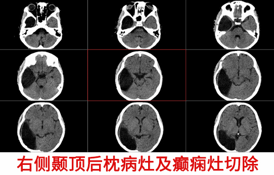 10歲男童癲癇4年 精準手術切癲癇灶“除根”