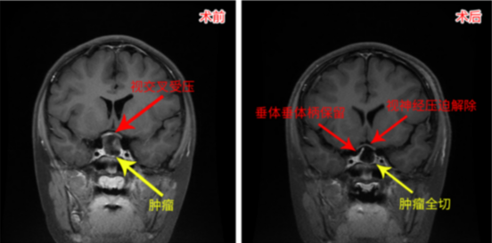 醫(yī)生媽媽：我要給我孩子找最好的顱咽管瘤手術(shù)團(tuán)隊(duì)