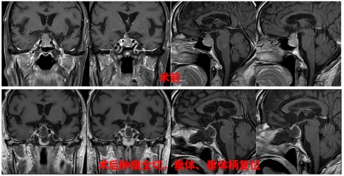  高齡是腦外科手術(shù)禁忌？三博腦科醫(yī)院86歲腦腫瘤患者術(shù)后3天順利出院