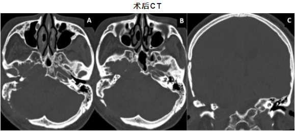 專訪首都醫(yī)科大學(xué)三博腦科醫(yī)院-張明山教授-側(cè)顱底腫瘤手術(shù)入路選擇探討