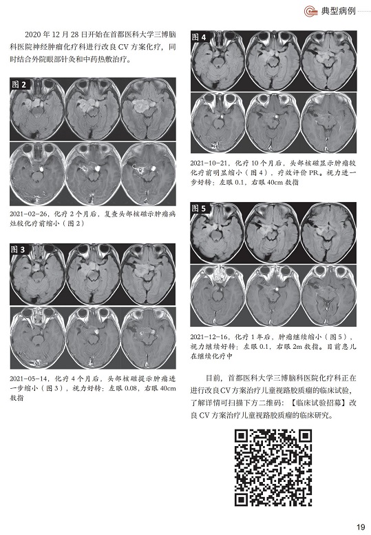 視路膠質(zhì)瘤患兒經(jīng)改良 CV 方案化療后效果顯著