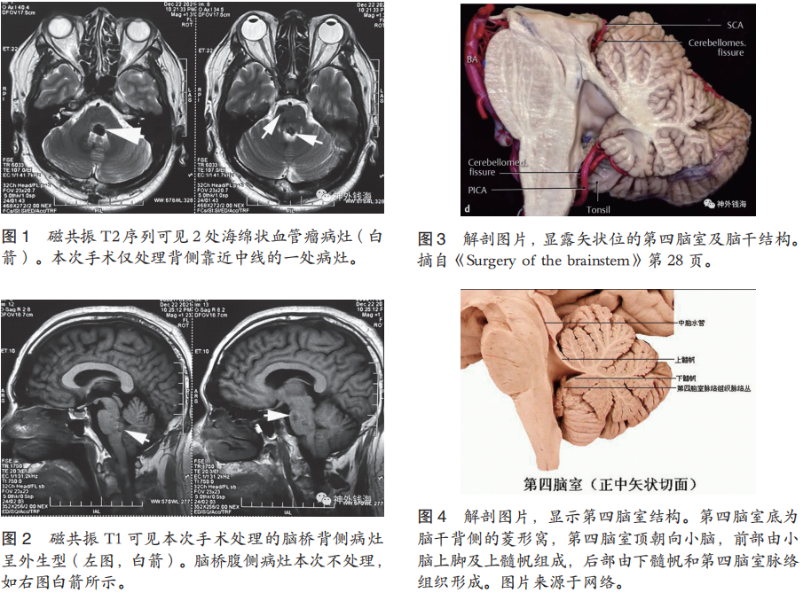 一例腦干海綿狀血管瘤的手術陷阱