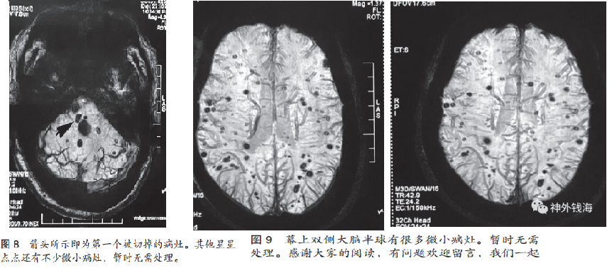 一例腦干海綿狀血管瘤的手術陷阱