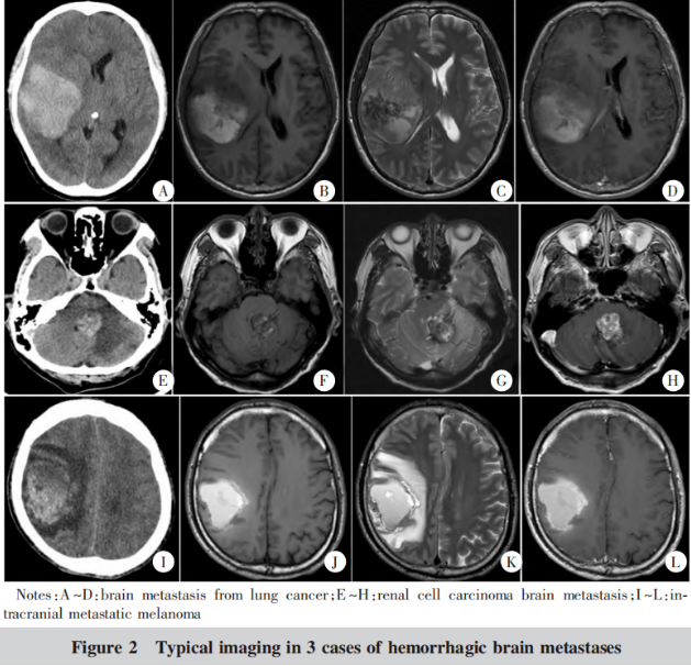 41例腦轉(zhuǎn)移瘤出血性瘤卒中的相關(guān)臨床因素分析1